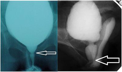 The Engagement of the Pelvic Floor Muscles to the Urethra, Does Variation in Point of Action Exist?